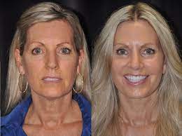 Effortless Elegance: Unveiling Santa Barbara’s Leading Facelift Surgeons post thumbnail image