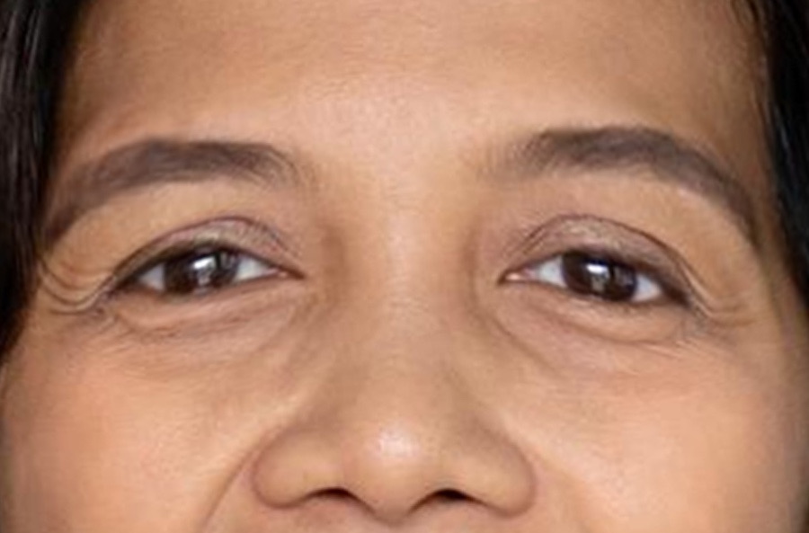 Things to Prevent After an Beneath Eye Filler Therapy post thumbnail image