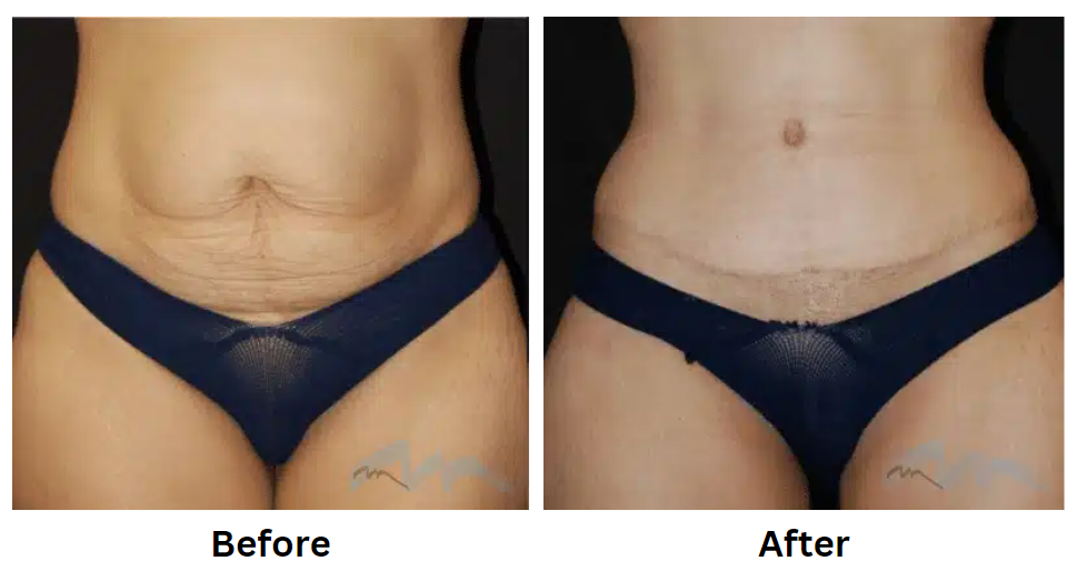 Turn Back the Clock with a Tummy Tuck in Miami post thumbnail image