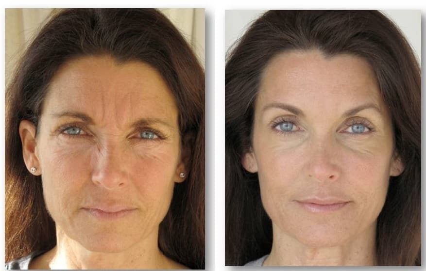 Easy Style: Unveiling Santa Barbara’s Leading Facelift Surgeons post thumbnail image