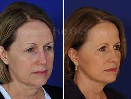 Timeless Beauty: The Art of Facelift in Santa Barbara post thumbnail image