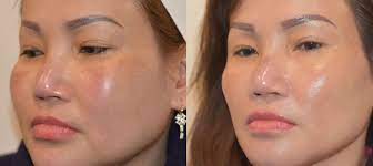 Effortless Beauty Solutions: Botox Near Me post thumbnail image